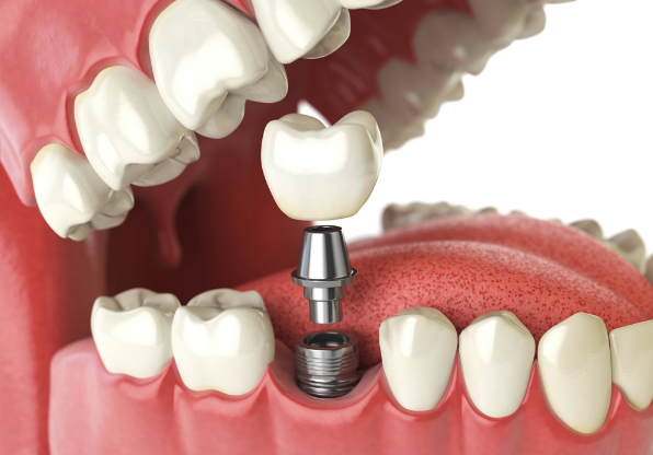 dental implant whitby