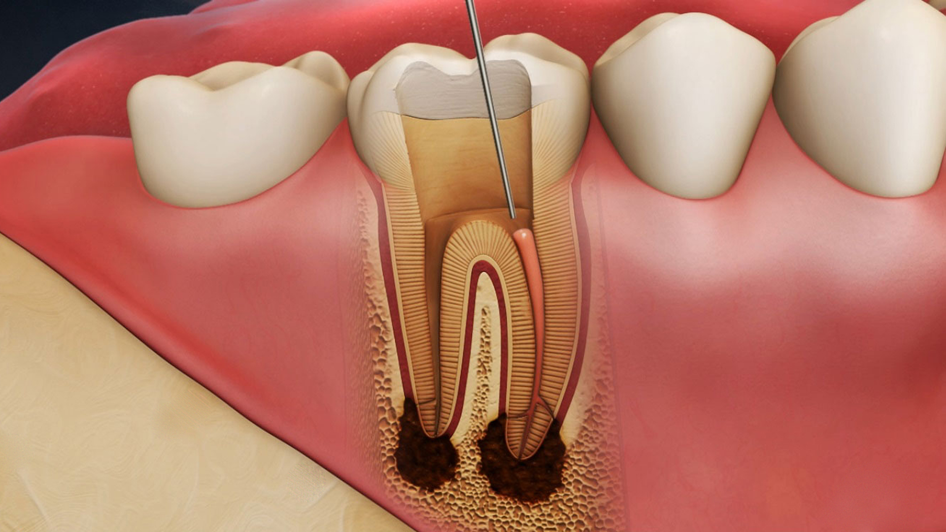 dental root canals whitby